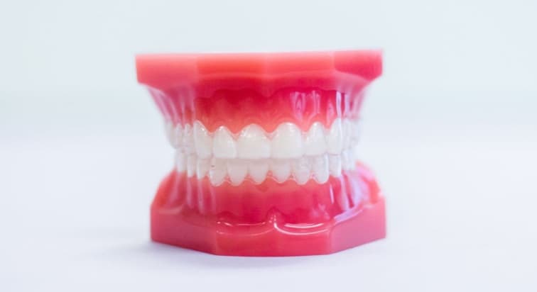 Clear Aligners image