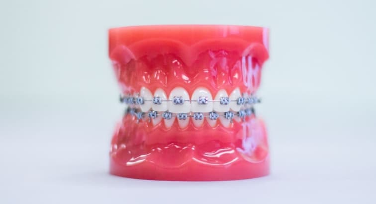 Metal Braces image