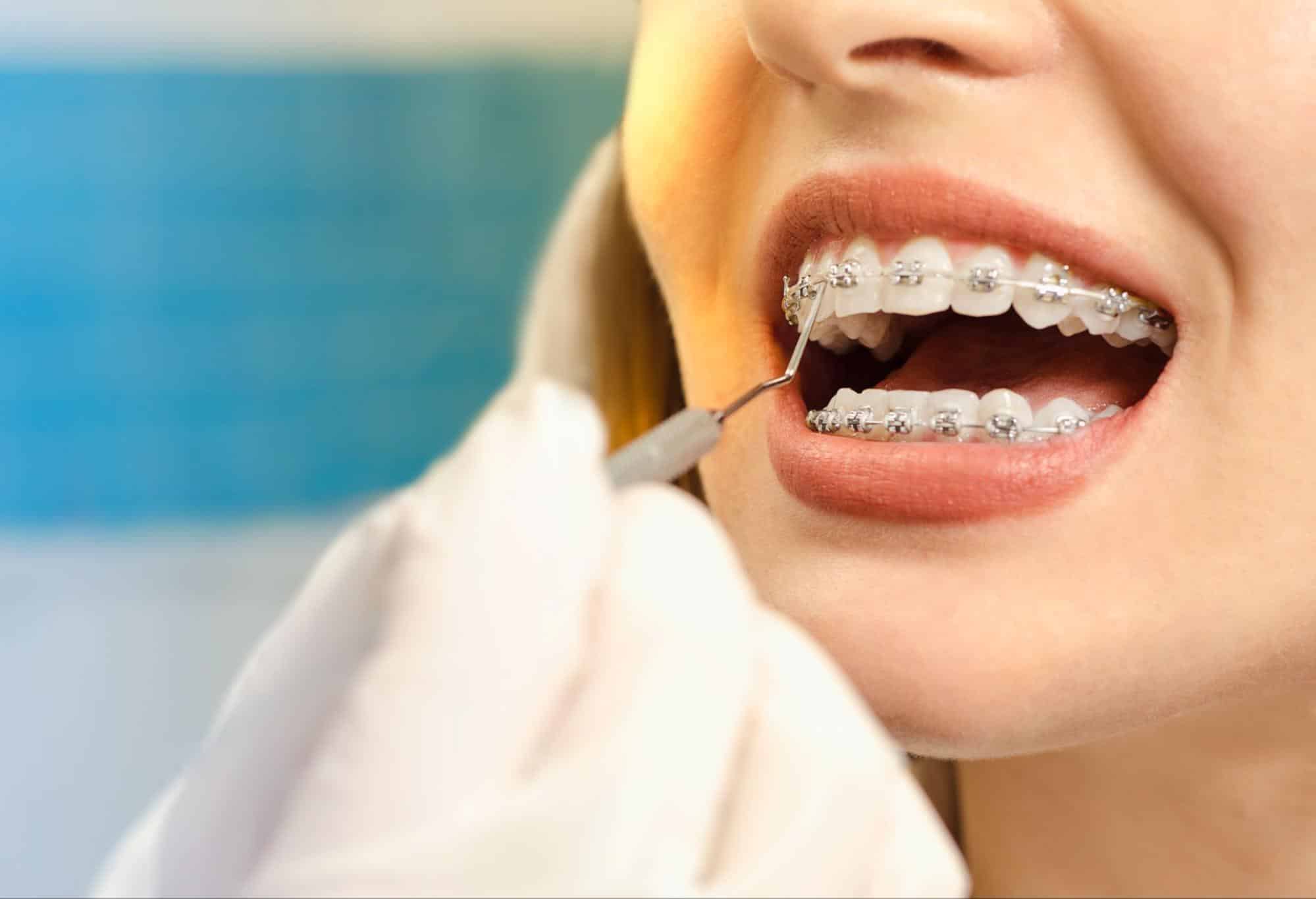 How Do Braces Move Teeth?